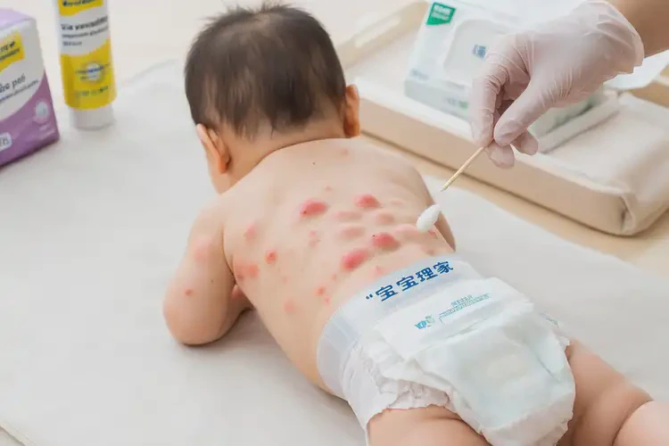 嬰兒肛周容易起濕疹能靠自己自愈嗎(圖4)