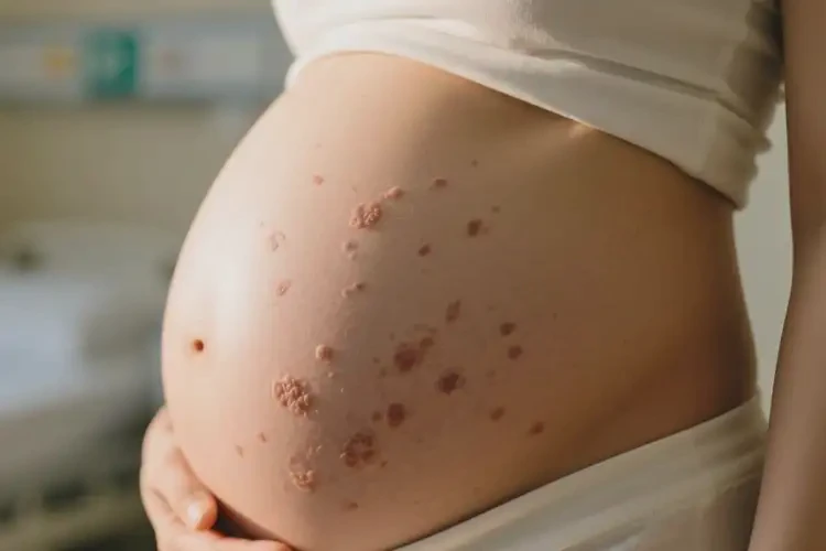 孕婦肚子容易起濕疹不管它會(huì)自己自愈嗎(圖4)
