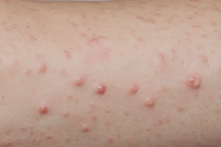 女人手臂偶爾長濕疹可不可以徹底自愈(圖4)