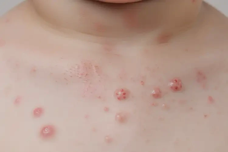 小孩脖子上容易起濕疹能靠自己自愈嗎(圖4)