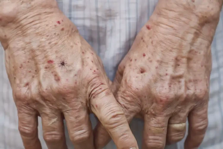高齡老人手上容易起濕疹不管它會自己自愈嗎(圖4)