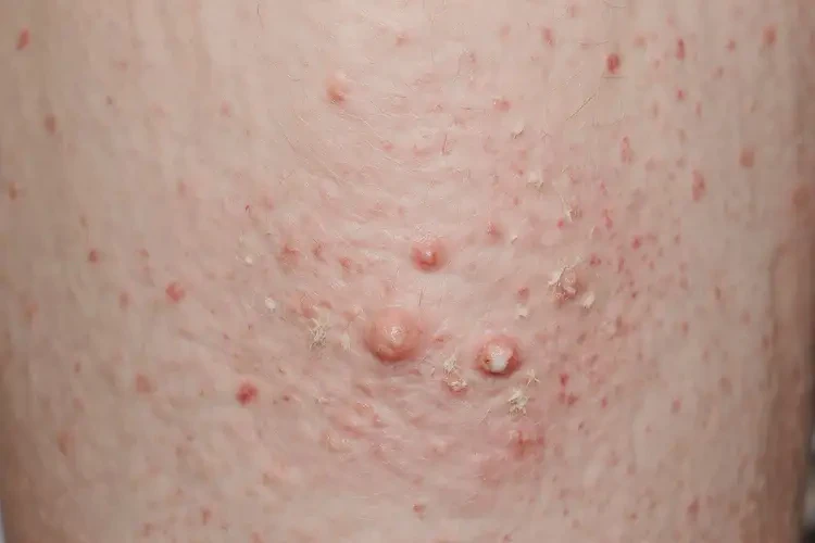 男生大腿上起濕疹能夠徹底治愈嗎(圖4)