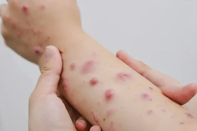 小兒全身起濕疹不管它會(huì)自己好嗎(圖4)