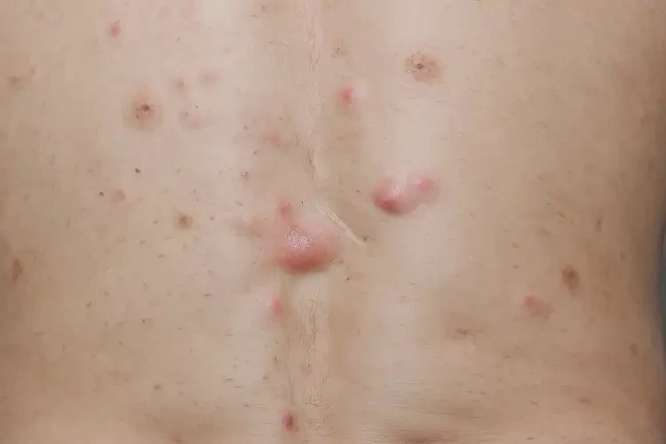 男生屁股上經(jīng)常長濕疹不管它會自己好嗎(圖4)