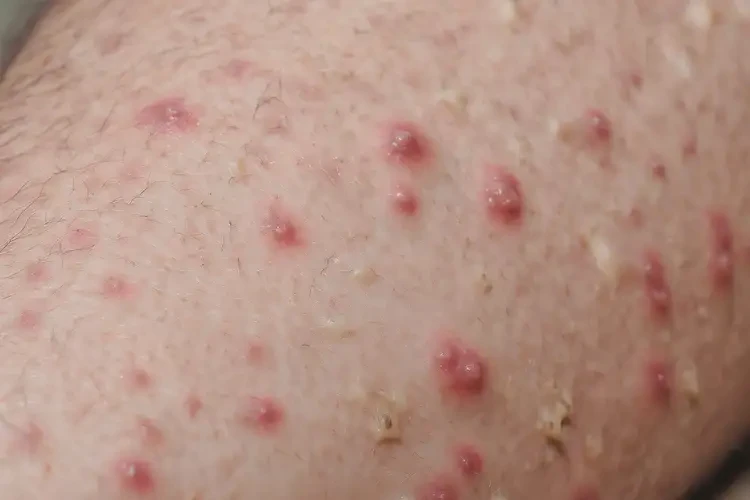 男人小腿出現(xiàn)濕疹能夠徹底治愈嗎(圖4)