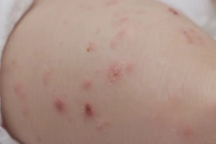 嬰兒大腿上容易長(zhǎng)濕疹不管它會(huì)自己好嗎(圖4)