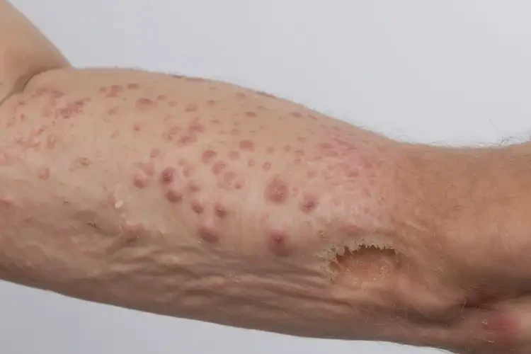 男人手臂經(jīng)常起濕疹能夠徹底治愈嗎(圖4)