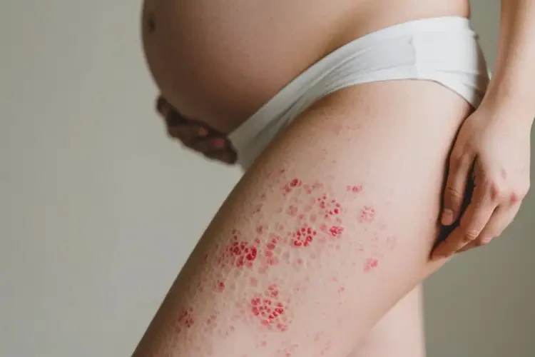 孕婦大腿有濕疹能夠徹底治愈嗎(圖4)