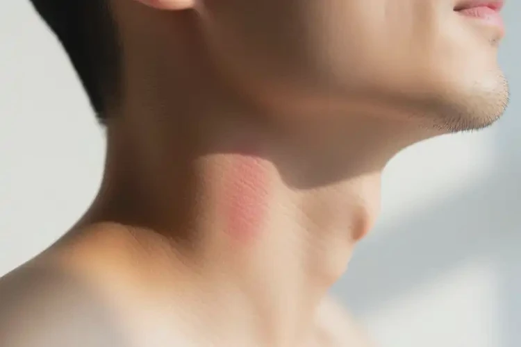 男性脖子上容易起濕疹能靠自己自愈嗎(圖3)