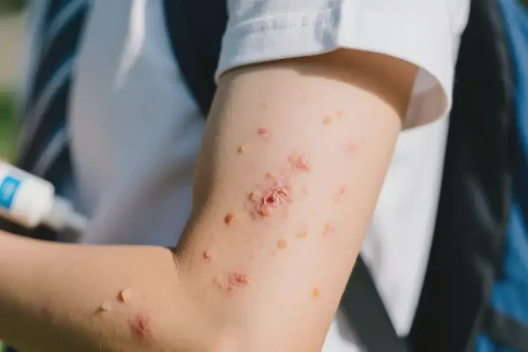 大學生手臂偶爾起濕疹不管它會自己痊愈嗎(圖2)