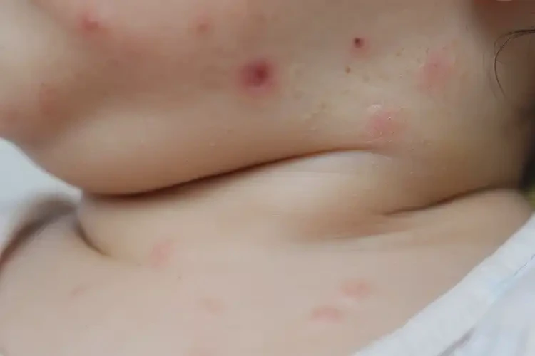 嬰幼兒脖子偶爾長濕疹不管它會自己痊愈嗎(圖4)