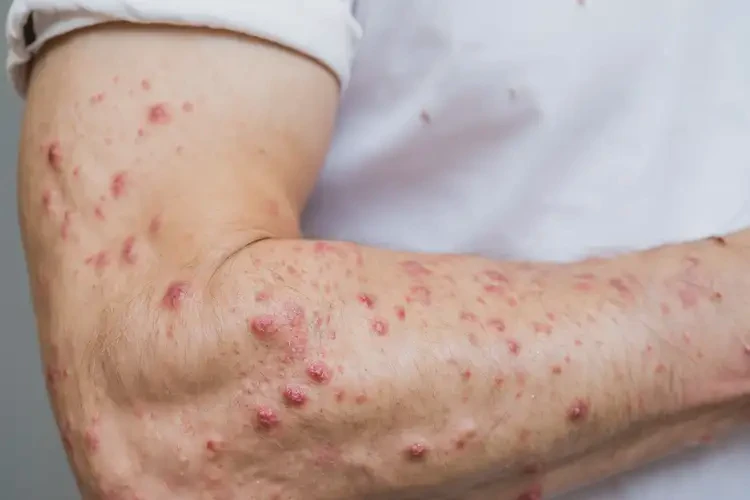 男性手臂出濕疹能靠自己自愈嗎(圖4)