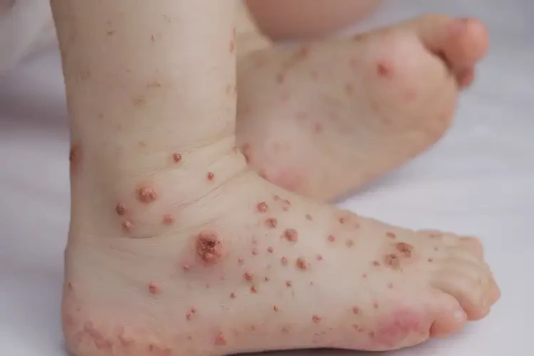 孩子腳上起濕疹能夠徹底治愈嗎(圖4)