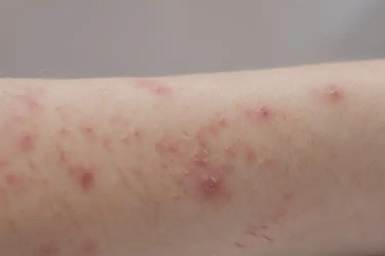 兒童手臂上偶爾長(zhǎng)濕疹不管它會(huì)自己好嗎(圖4)