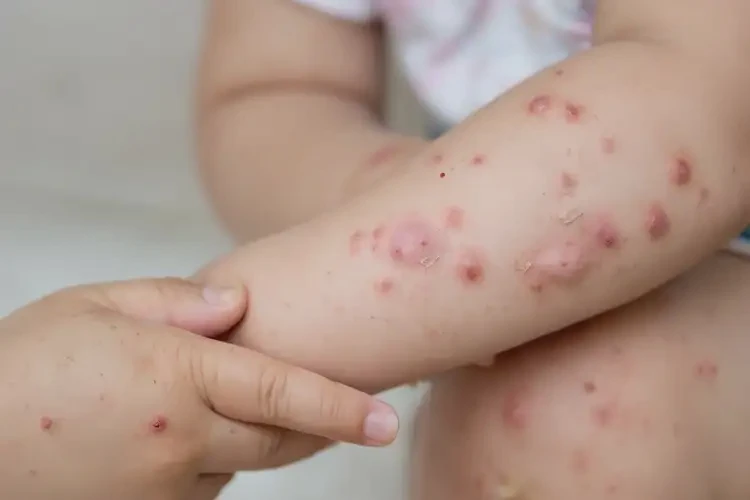 小孩手臂上容易起濕疹不管它會自己好嗎(圖4)