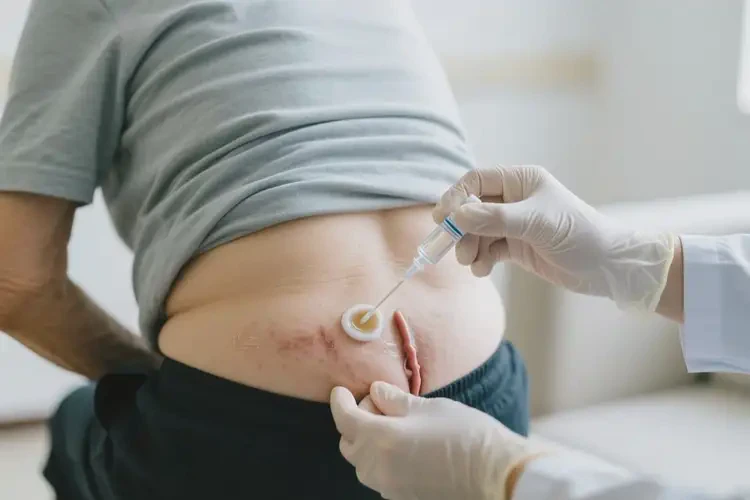 老年人肛周偶爾長(zhǎng)濕疹能夠徹底治愈嗎(圖3)