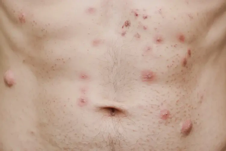 青年人肚子上出濕疹不管它會自己自愈嗎(圖4)