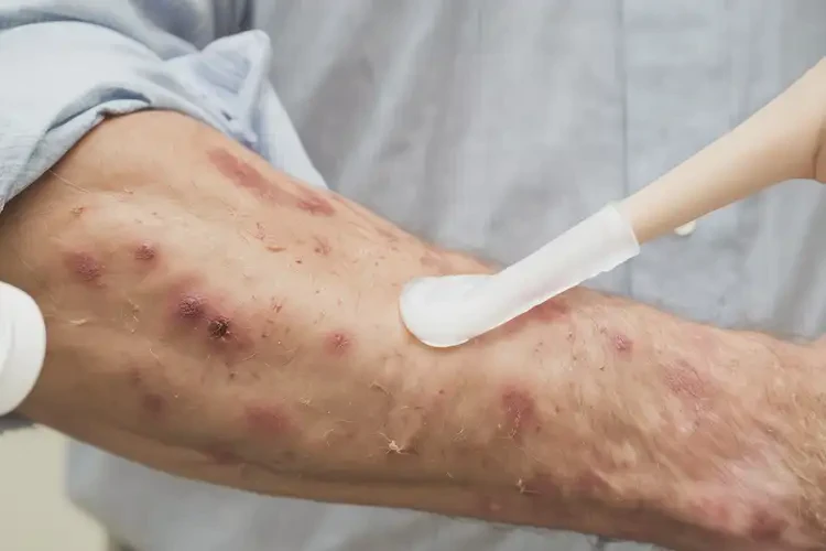 男性手臂起濕疹不管它會(huì)自己痊愈嗎(圖3)