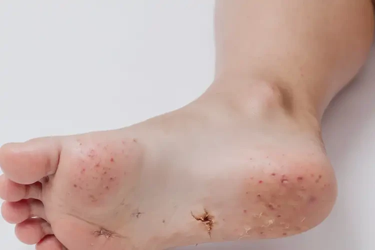 孩子腳上有濕疹能夠徹底治愈嗎(圖4)