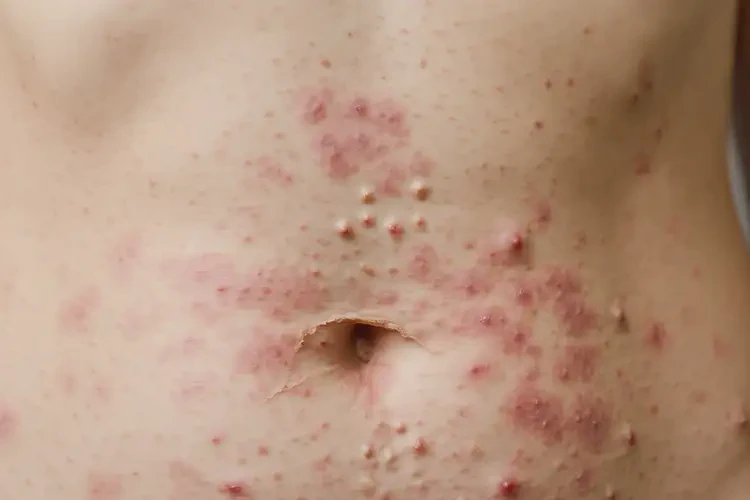 女生肚子有濕疹可以徹底自愈嗎(圖4)