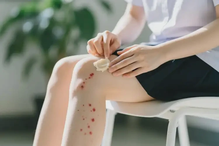 大學生大腿經常起濕疹能夠徹底治愈嗎(圖4)