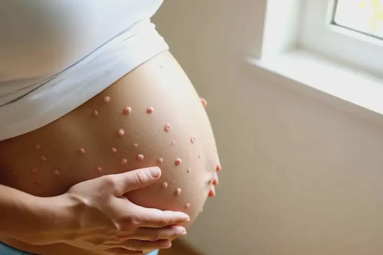 孕婦肚子容易起濕疹不管它會(huì)自己自愈嗎(圖2)