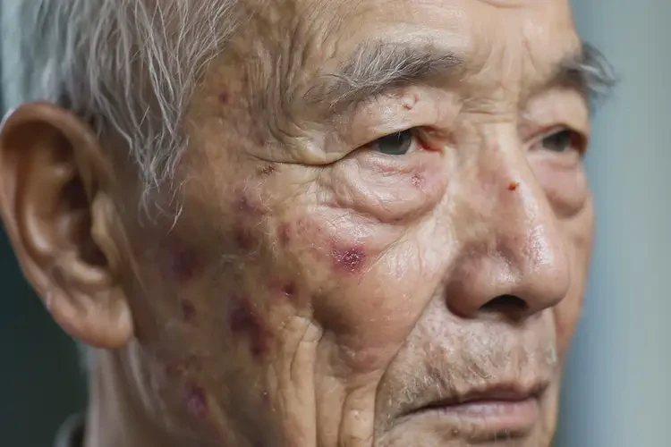 高齡老人面部偶爾長濕疹不管它會自己好嗎(圖4)