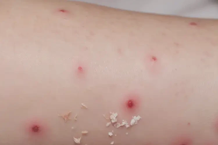 嬰幼兒手臂上出現(xiàn)濕疹不管它會自己痊愈嗎(圖4)