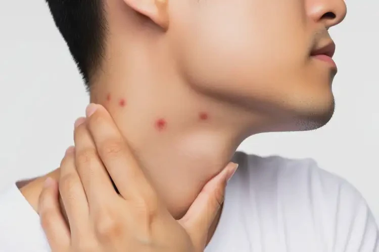 青年人脖子上容易起濕疹可以徹底自愈嗎(圖1)