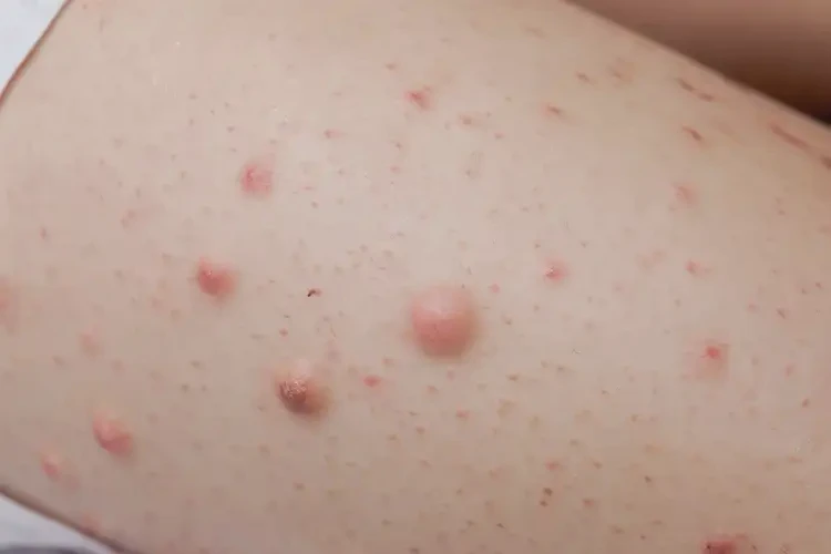 小兒大腿上長(zhǎng)濕疹可不可以徹底自愈(圖4)