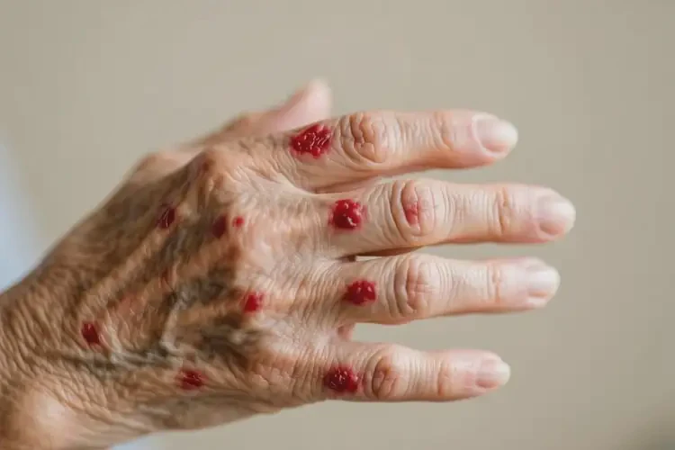 老年人手上出濕疹不管它會(huì)自己自愈嗎(圖3)
