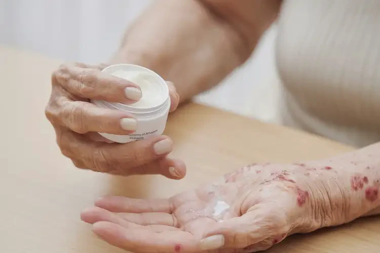 老人手上容易長(zhǎng)濕疹可不可以徹底自愈(圖3)