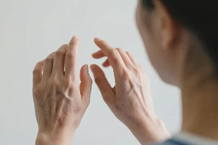 女人手上經(jīng)常起濕疹能夠徹底治愈嗎(圖2)