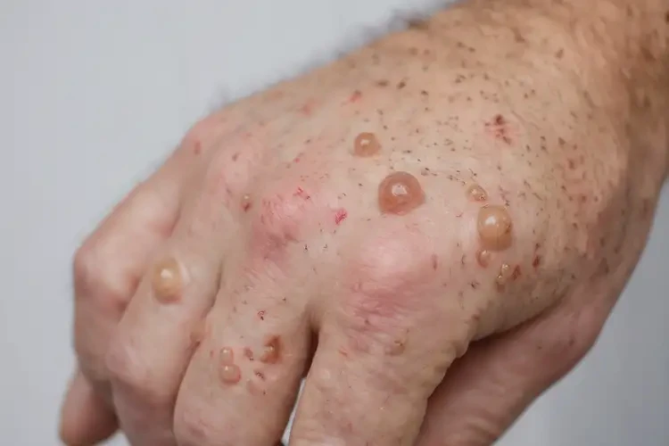 男生手上長濕疹不管它會自己自愈嗎(圖4)