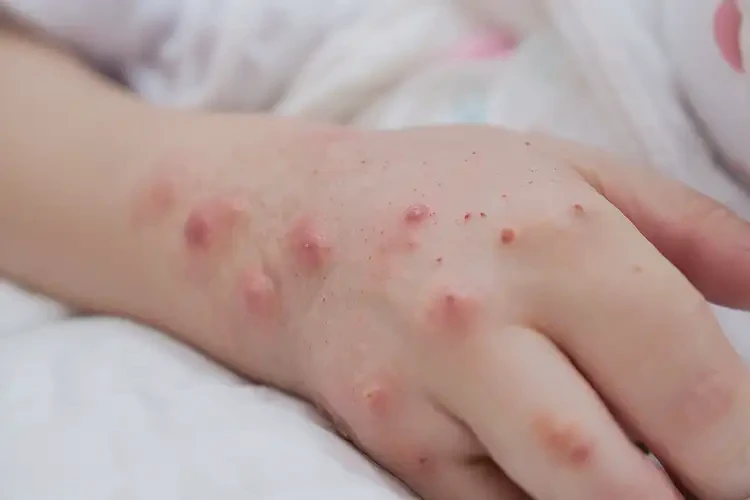 哺乳期媽媽手上容易長(zhǎng)濕疹不管它會(huì)自己痊愈嗎(圖4)