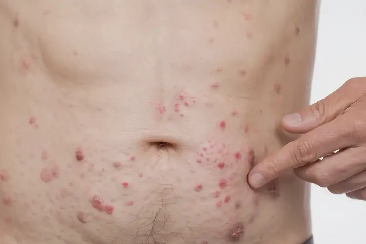 男人肚子經(jīng)常長濕疹不管它會自己自愈嗎(圖4)