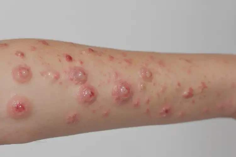 孩子手臂起濕疹不管它會(huì)自己自愈嗎(圖3)