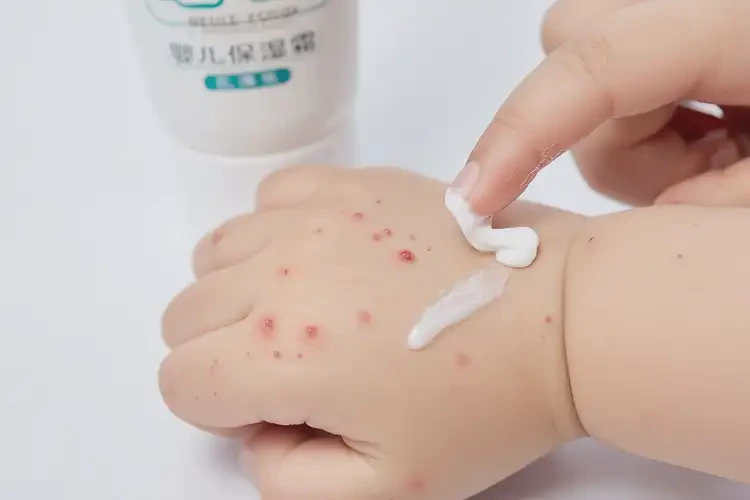 小孩手上偶爾長濕疹不管它會自己好嗎(圖4)