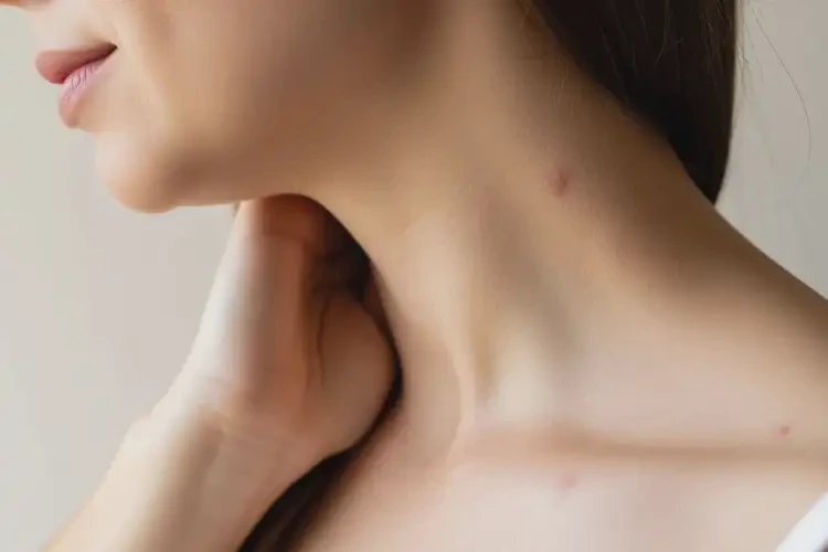 孕婦脖子偶爾長濕疹能靠自己自愈嗎(圖2)