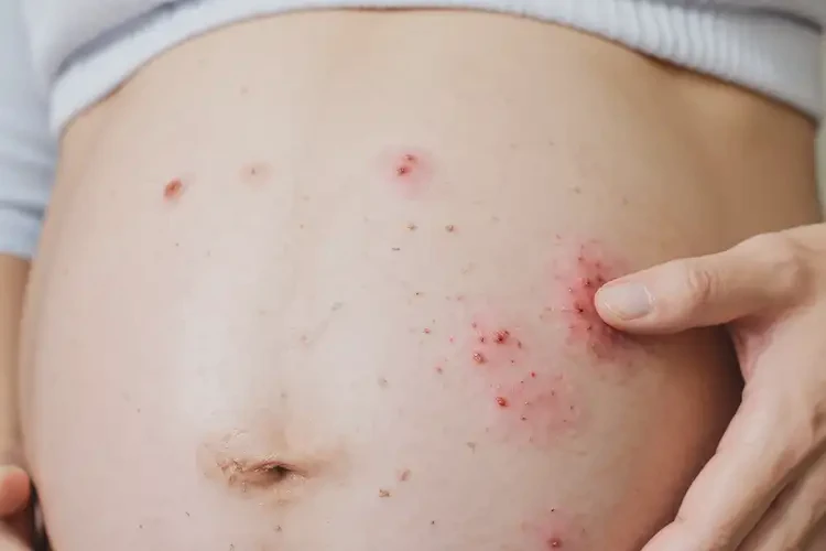 孕婦屁股出濕疹不管它會(huì)自己痊愈嗎(圖4)