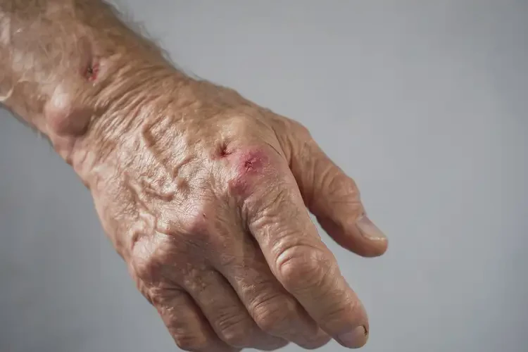 老年人手上長濕疹能不能徹底自愈(圖4)