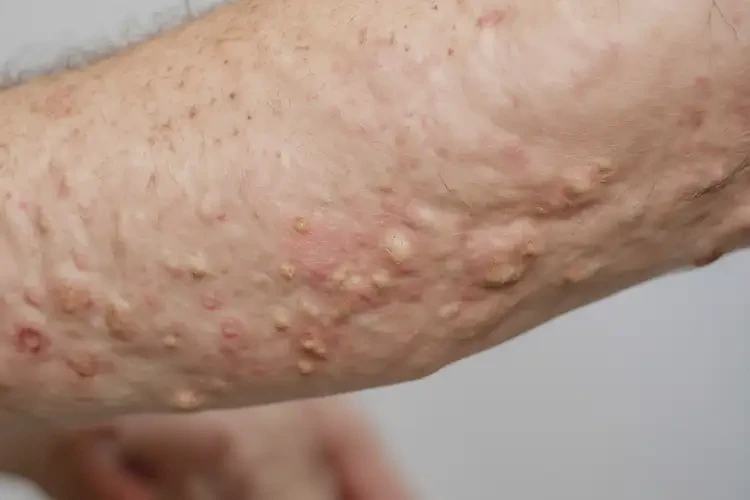 男人手臂上容易長(zhǎng)濕疹能夠徹底治愈嗎(圖4)