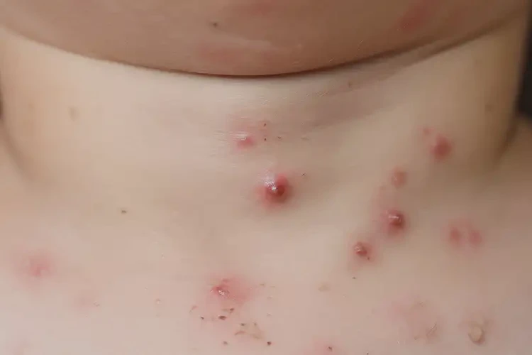 孩子脖子經(jīng)常長濕疹不管它會自己自愈嗎(圖4)