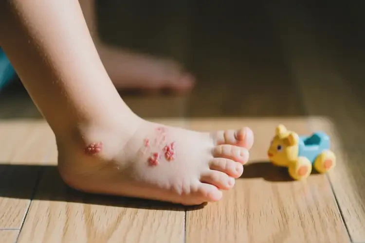 小孩腳上有濕疹不管它會自己好嗎(圖2)