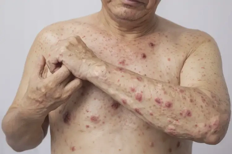 青年人全身出现湿疹可不可以彻底自愈(图4)