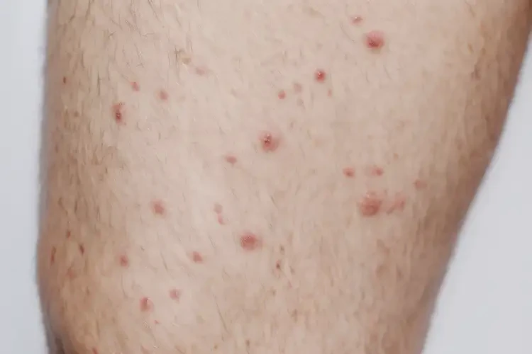 男性大腿偶尔起湿疹能靠自己自愈吗(图4)