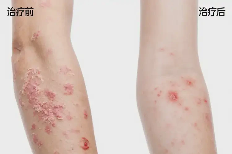 青少年手臂上經(jīng)常起濕疹能不能徹底自愈(圖1)