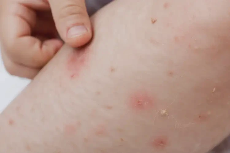 少兒小腿上出濕疹不管它會自己痊愈嗎(圖4)