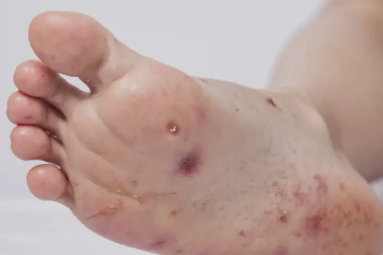 兒童腳上經常長濕疹能靠自己自愈嗎(圖4)