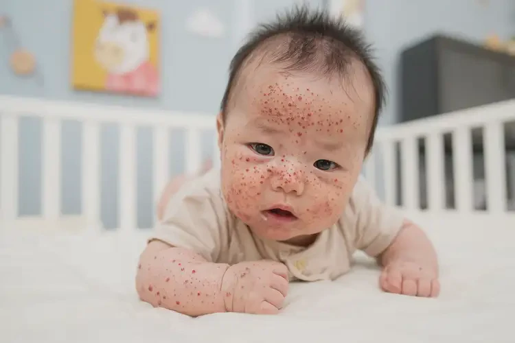 嬰兒四肢經(jīng)常起濕疹不管它會自己痊愈嗎(圖4)